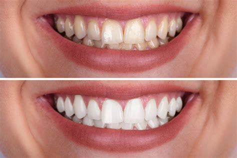 does zoom whitening ruin enamel.